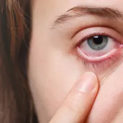 Occhio arrossato e irritato, con palpebra inferiore visibilmente infiammata, sintomo di congiuntivite allergica.
