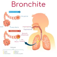 Illustrazione della bronchite: vie aeree sane e infiammate, con sintomi. Potrebbe essere utile un antibiotico per bronchite.