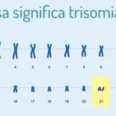 Il cariotipo mostra la trisomia 21, la causa della sindrome di Down. Le cause di morte in questi casi sono spesso legate a complicazioni cardiache o respiratorie.