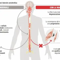 Illustrazione sui sintomi SLA: degenerazione dei motoneuroni, atrofia muscolare e paralisi progressiva.