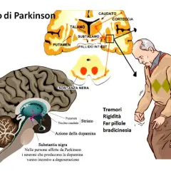 Illustrazione del cervello e di un uomo con tremori, sintomi del Parkinson. La sostanza nera degenera, influenzando la dopamina. Non si specifica in quanto tempo degenera il parkinson.