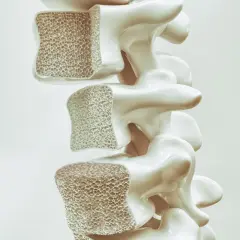 Sezione di vertebre con osso spugnoso. Prolia a cosa serve: aiuta a rafforzare le ossa fragili, contrastando l'osteoporosi.
