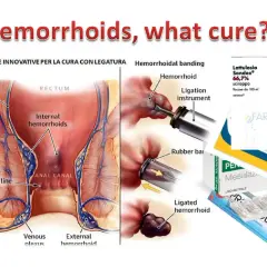 Illustrazione anatomica emorroidi e tecniche di legatura. Farmaci come Pentacol a cosa serve per il trattamento.