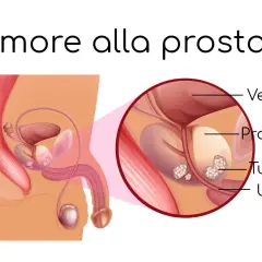 Illustrazione anatomica della prostata con tumore. La diagnosi precoce è fondamentale: il tumore alla prostata si guarisce.