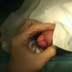 Mano guantata che esegue la circoncisione di un bambino. Si vedono suture e garze.