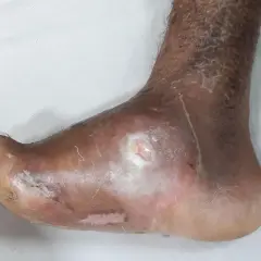 Piede con lesioni cutanee e ulcere, possibili forxiga effetti collaterali. Pelle secca e screpolata sulla caviglia.