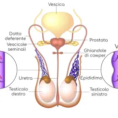 Illustrazione anatomica del sistema riproduttivo maschile. A destra, un varicocele mostra vene dilatate e gonfie, suggerendo testicoli gonfi.