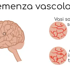 Illustrazione del cervello con la scritta "Demenza vascolare". A destra, vasi sanguigni sani e vasi colpiti da attacchi ischemici transitori.