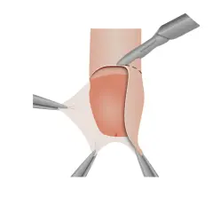 Illustrazione di un pene non circonciso durante un intervento chirurgico, con rimozione del prepuzio e sutura.