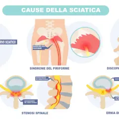 Illustrazione delle cause della sciatica: nervo sciatico infiammato, sindrome del piriforme, discopatia degenerativa, stenosi spinale ed ernia del disco.