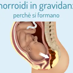 Illustrazione anatomica che mostra il feto nell'utero e la causa delle emorroidi in gravidanza, con un'area evidenziata.