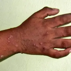 Mani e avambraccio con lesioni cutanee, possibili sintomi di una malattia che colpisce mani, bocca e piedi.
