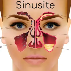Illustrazione anatomica dei seni paranasali, evidenziando infiammazione e muco, causa comune di mal di testa da sinusite.