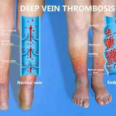 Gambe gonfie e arrossate, con un'illustrazione che mostra la flebite gamba sintomi: un trombo blocca il flusso sanguigno.