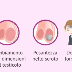 Illustrazione di sintomi: nodulo, cambiamento dimensioni testicolo, pesantezza scroto, dolore lombare, tenerezza seno. Possibile dolore testicolo sinistro.