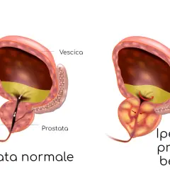 Confronto tra prostata normale e prostata ingrossata: sintomi e cure. L'ipertrofia prostatica benigna comprime l'uretra, ostacolando il flusso urinario.