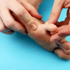 Mani che esaminano un piede con pelle secca e screpolata, suggerendo la presenza di funghi ai piedi.