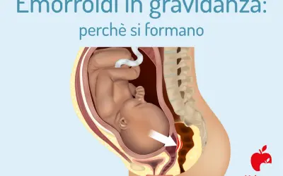 Illustrazione anatomica che mostra il feto nell'utero e la causa delle emorroidi in gravidanza, con un'area evidenziata.