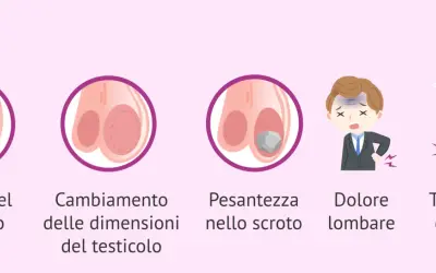 Illustrazione di sintomi: nodulo, cambiamento dimensioni testicolo, pesantezza scroto, dolore lombare, tenerezza seno. Possibile dolore testicolo sinistro.