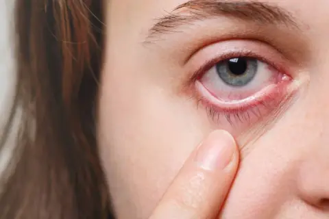 Occhio arrossato e irritato, con palpebra inferiore visibilmente infiammata, sintomo di congiuntivite allergica.