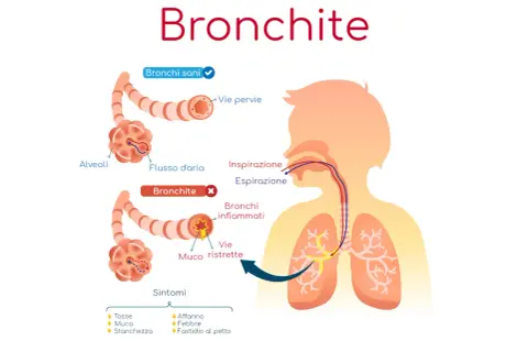 Illustrazione della bronchite: vie aeree sane e infiammate, con sintomi. Potrebbe essere utile un antibiotico per bronchite.