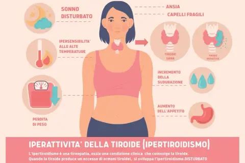 Sintomi tiroide nelle donne: sonno disturbato, ansia, perdita di peso, sudorazione, aumento appetito, ipersensibilità al caldo, capelli fragili.