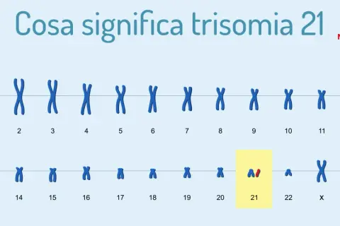 Il cariotipo mostra la trisomia 21, la causa della sindrome di Down. Le cause di morte in questi casi sono spesso legate a complicazioni cardiache o respiratorie.