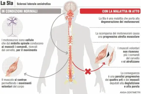 Illustrazione sui sintomi SLA: degenerazione dei motoneuroni, atrofia muscolare e paralisi progressiva.