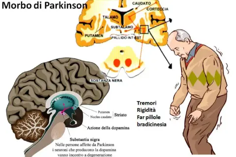 Illustrazione del cervello e di un uomo con tremori, sintomi del Parkinson. La sostanza nera degenera, influenzando la dopamina. Non si specifica in quanto tempo degenera il parkinson.
