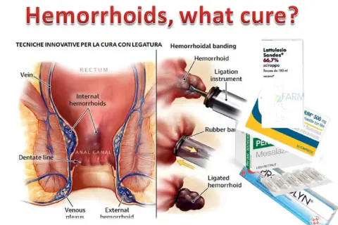 Illustrazione anatomica emorroidi e tecniche di legatura. Farmaci come Pentacol a cosa serve per il trattamento.