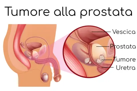 Illustrazione anatomica della prostata con tumore. La diagnosi precoce è fondamentale: il tumore alla prostata si guarisce.