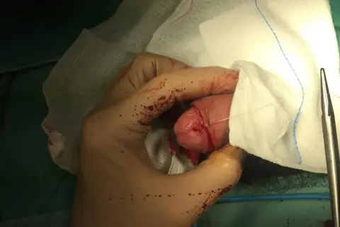 Mano guantata che esegue la circoncisione di un bambino. Si vedono suture e garze.