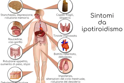 Ipotiridismo: stanchezza, depressione, problemi di memoria, ingrossamento della tiroide e altri sintomi.