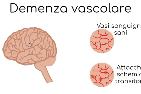 Illustrazione del cervello con la scritta "Demenza vascolare". A destra, vasi sanguigni sani e vasi colpiti da attacchi ischemici transitori.