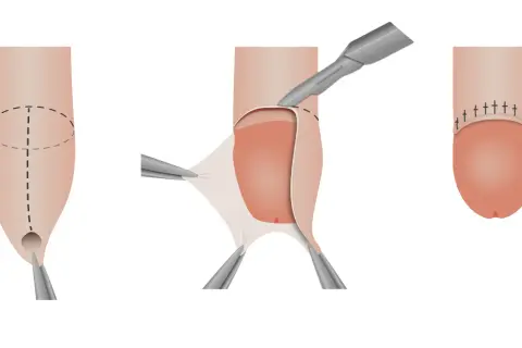 Illustrazione di un pene non circonciso durante un intervento chirurgico, con rimozione del prepuzio e sutura.