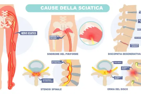 Illustrazione delle cause della sciatica: nervo sciatico infiammato, sindrome del piriforme, discopatia degenerativa, stenosi spinale ed ernia del disco.