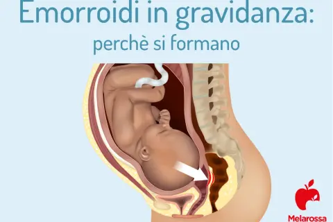 Illustrazione anatomica che mostra il feto nell'utero e la causa delle emorroidi in gravidanza, con un'area evidenziata.