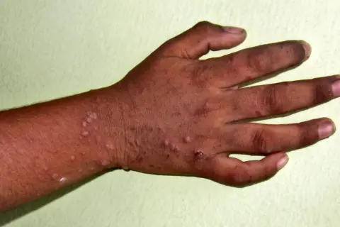 Mani e avambraccio con lesioni cutanee, possibili sintomi di una malattia che colpisce mani, bocca e piedi.
