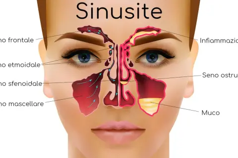 Illustrazione anatomica dei seni paranasali, evidenziando infiammazione e muco, causa comune di mal di testa da sinusite.