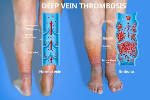 Gambe gonfie e arrossate, con un'illustrazione che mostra la flebite gamba sintomi: un trombo blocca il flusso sanguigno.
