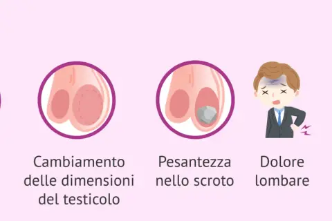 Illustrazione di sintomi: nodulo, cambiamento dimensioni testicolo, pesantezza scroto, dolore lombare, tenerezza seno. Possibile dolore testicolo sinistro.