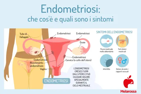 Illustrazione anatomica dell'utero e delle ovaie che mostra la crescita di tessuto endometriale fuori dall'utero, con i principali sintomi dell'endometriosi: flusso abbondante, dolori mestruali, infertilità e dolore durante i rapporti sessuali.