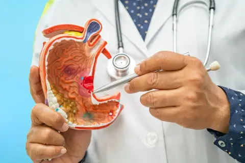 Modello anatomico dello stomaco, con un dito che indica un'area che potrebbe rappresentare una gastropatia antrale.