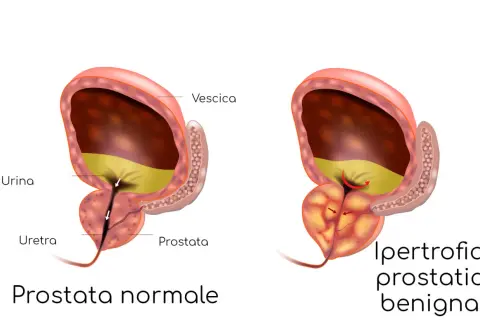 Confronto tra prostata normale e prostata ingrossata: sintomi e cure. L'ipertrofia prostatica benigna comprime l'uretra, ostacolando il flusso urinario.