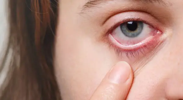 Occhio arrossato e irritato, con palpebra inferiore visibilmente infiammata, sintomo di congiuntivite allergica.