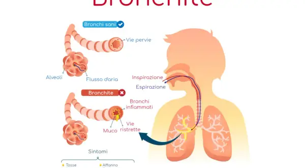 Illustrazione della bronchite: vie aeree sane e infiammate, con sintomi. Potrebbe essere utile un antibiotico per bronchite.