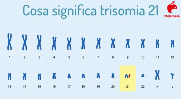 Il cariotipo mostra la trisomia 21, la causa della sindrome di Down. Le cause di morte in questi casi sono spesso legate a complicazioni cardiache o respiratorie.