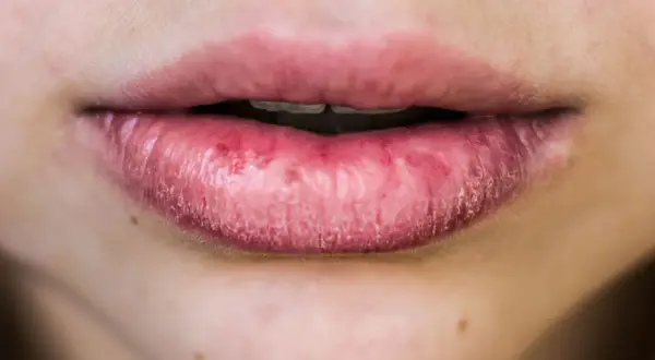 Labbra secche e screpolate, possibili cause psicologiche legate a stress o ansia.