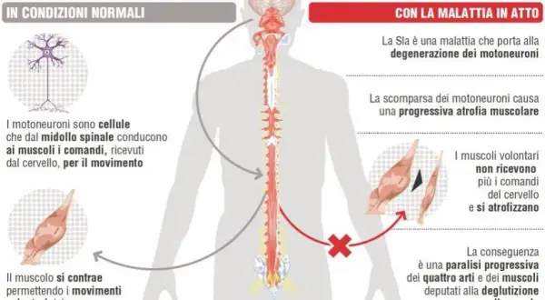 Illustrazione sui sintomi SLA: degenerazione dei motoneuroni, atrofia muscolare e paralisi progressiva.