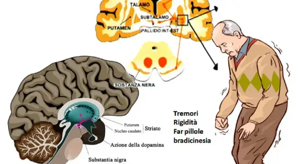 Illustrazione del cervello e di un uomo con tremori, sintomi del Parkinson. La sostanza nera degenera, influenzando la dopamina. Non si specifica in quanto tempo degenera il parkinson.